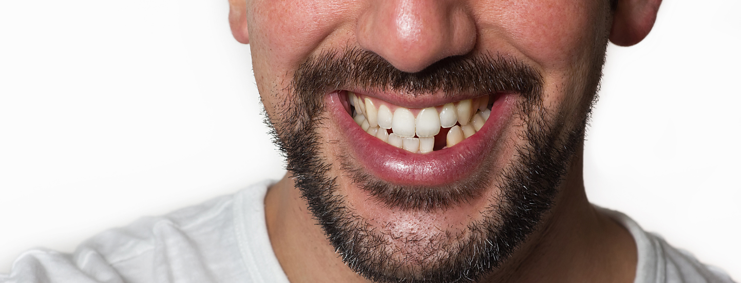Man with missing front teeth smiling