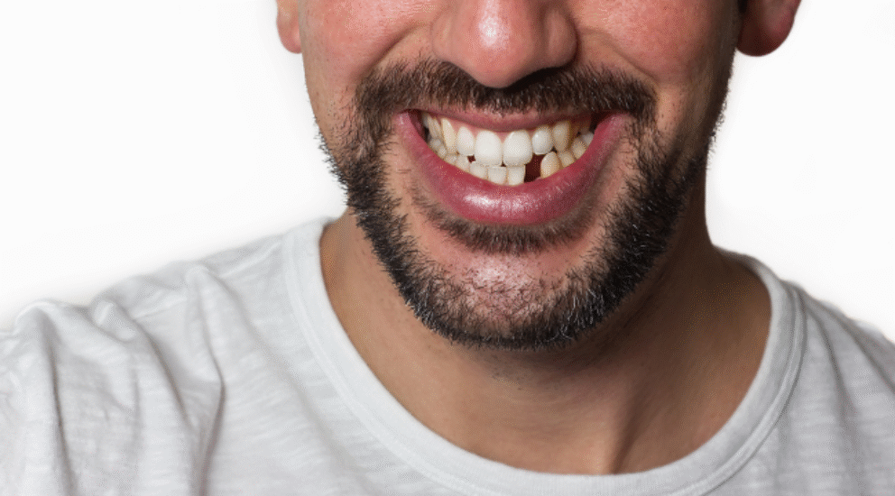Man with missing front teeth smiling