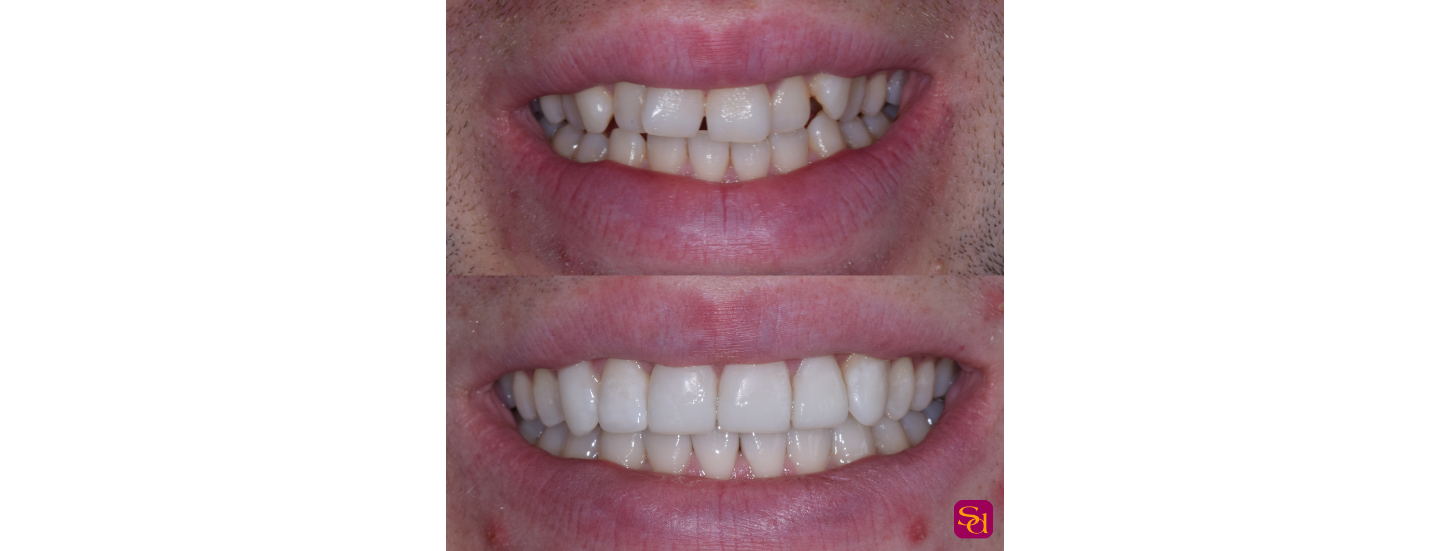 Before and after clear aligner treatment showing teeth straightening results with Invisalign at Sale Dental in Cheshire