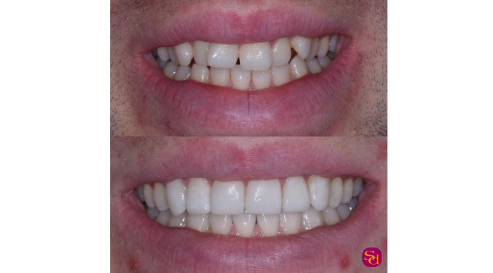 Before and after clear aligner treatment showing teeth straightening results with Invisalign at Sale Dental in Cheshire